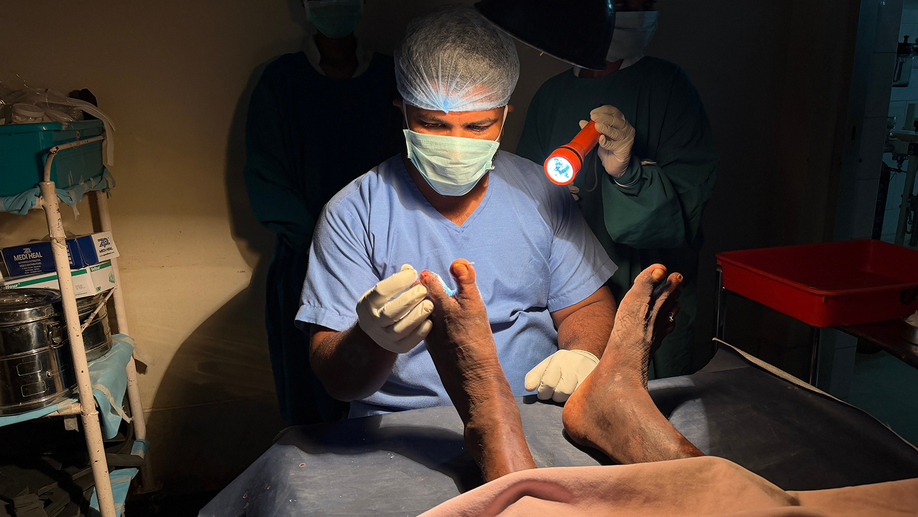 Specialized treatment for foot corn